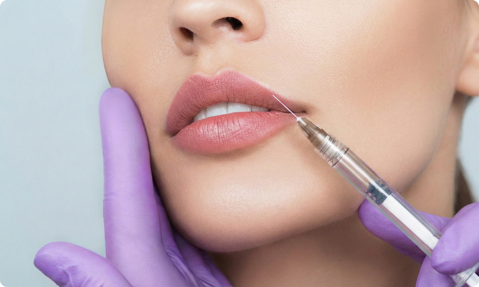 Lip filler